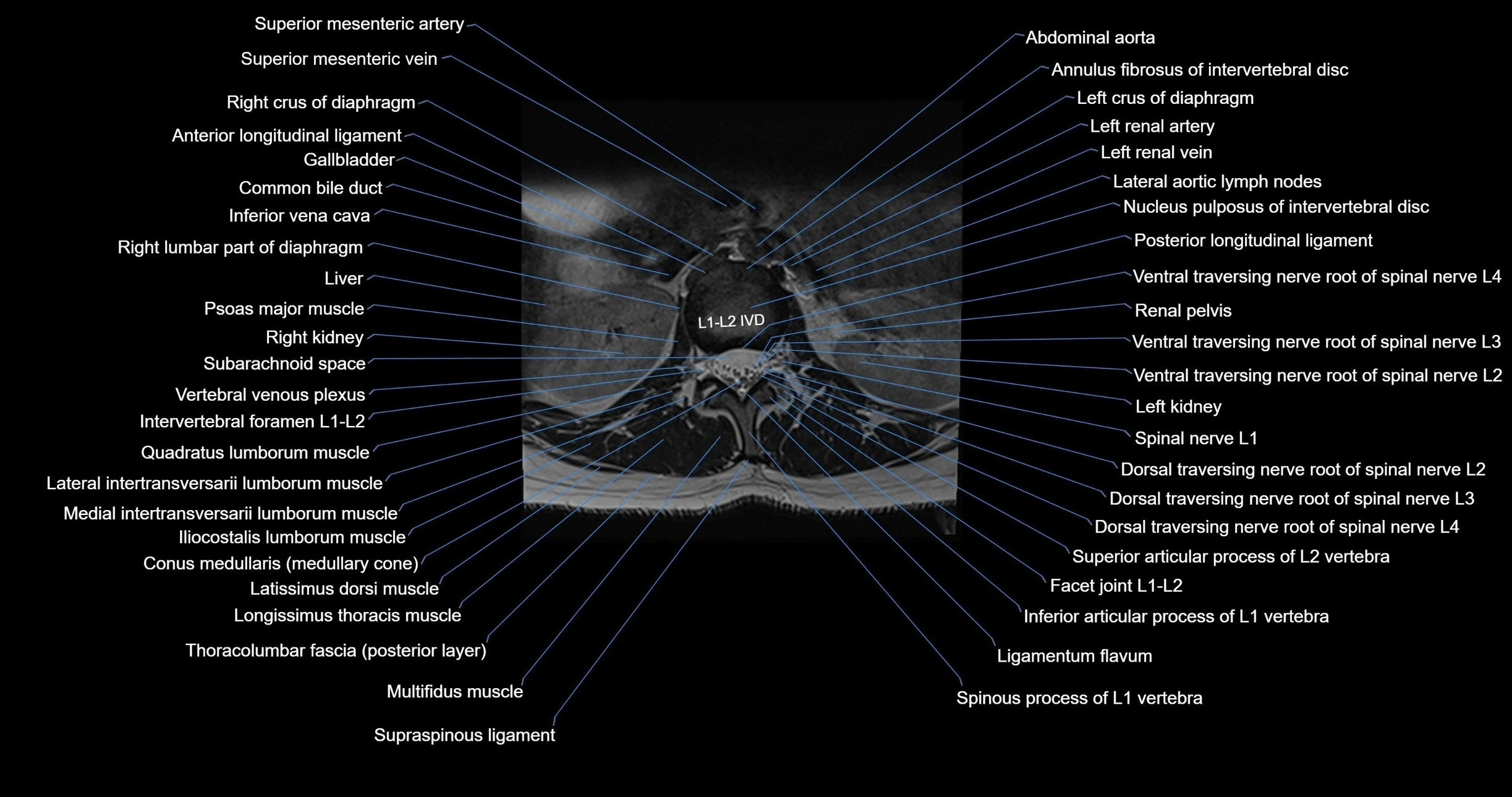 MRI lumbar spine axial cross sectional anatomy 3T radiology  image-img-00001-00011.webp